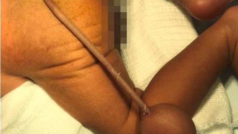 Bayi Prematur Ini Lahir dengan Ekor Sepanjang 12 cm, Dokter: Kejadian sangat Langka