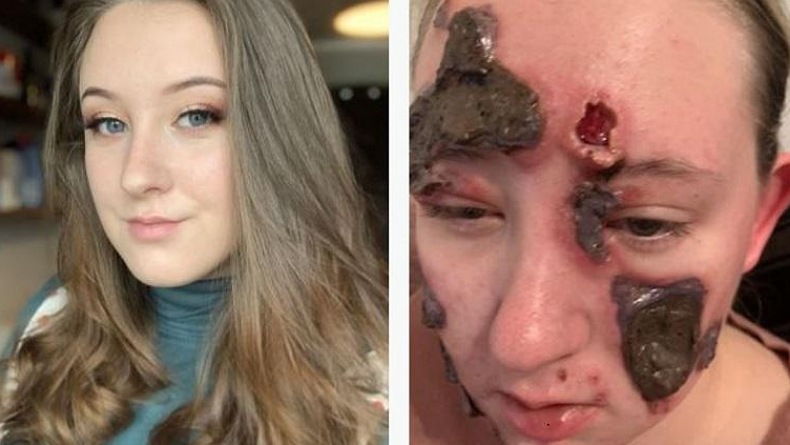 Wajah Cantik Berubah Menakutkan, Remaja Putri Ini Penuh Koreng dan Nanah
