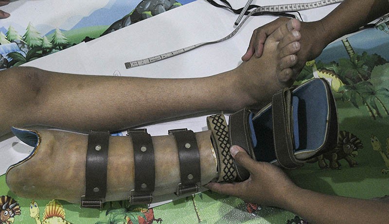 Pembuatan Kaki Palsu di Bekasi, Dijual hingga Puluhan Juta Rupiah - Bagian 1