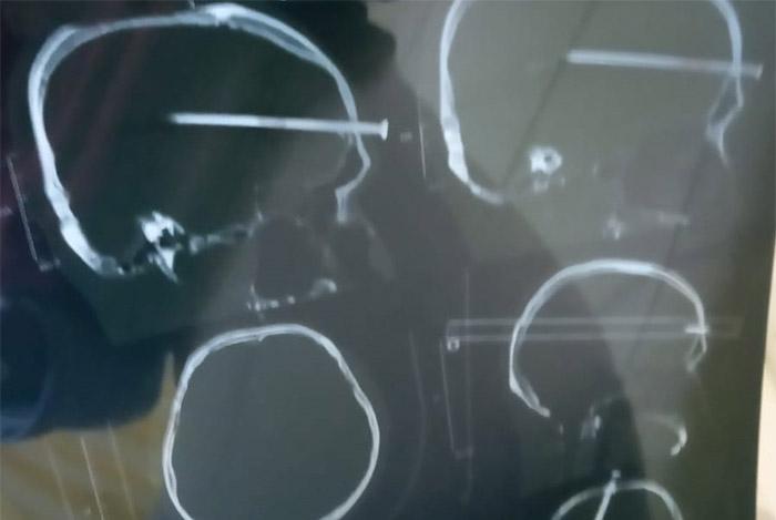 Depresi Diceraikan Istri, Pria Gunungkidul Tancapkan Paku 14 Cm ke Dahi Sendiri