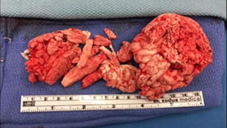 Istri Nekat Masukkan Busa Pengeras ke Penis Suami agar Ereksi, Ini yang Terjadi