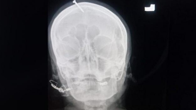 Dukun Ini Tancapkan Paku di Kepala Ibu Hamil, Warga Masih Percaya Mistik