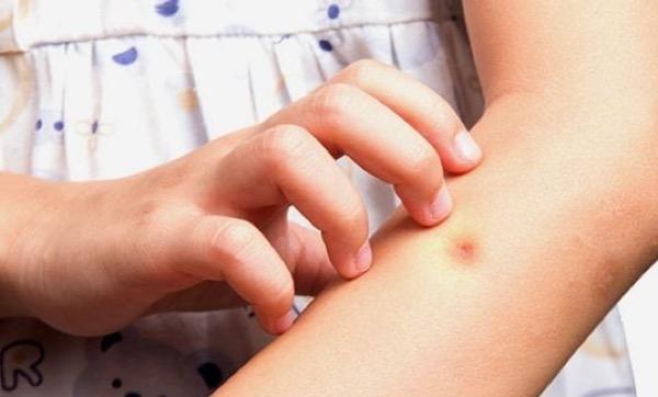 7 Cara Mengatasi Bisul agar Cepat Kempes, Nomor 5 Perlu Dicoba