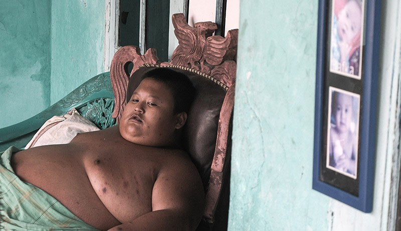 Potret Penderita Obesitas Asal Bekasi, Umur 11 Tahun Berat Badan 115 Kg - Bagian 2