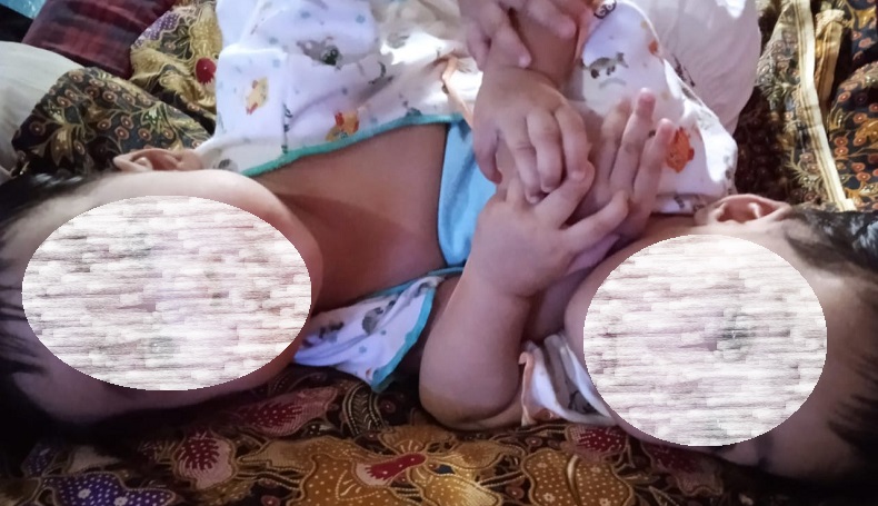Biaya Pemisahan Bayi Kembar Siam di Sukabumi Rp1,5 Miliar, Orang Tua Kebingungan