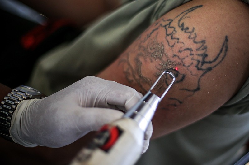 Layanan Hapus Tato Gratis di Jakarta Barat - Bagian 1