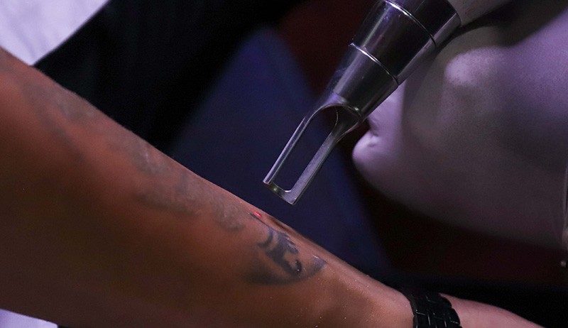 Layanan Hapus Tato Gratis di Jakarta Selatan - Bagian 2