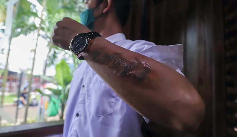 Layanan Hapus Tato Gratis di Jakarta Selatan - Bagian 3