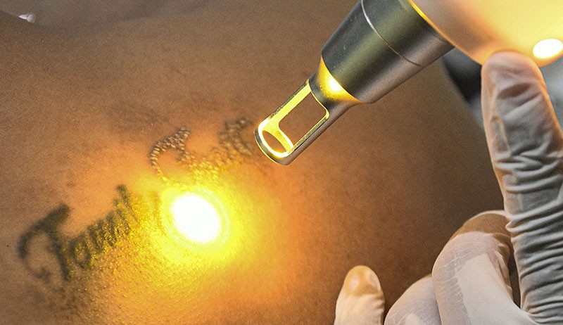 Layanan Hapus Tato Gratis di Bekasi hingga 25 April - Bagian 1