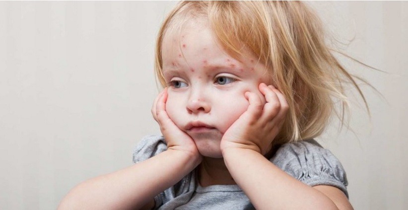 Ciri-Ciri Penyakit Tangan Kaki dan Mulut yang Menyerang Anak-Anak, Ini Penyebabnya 