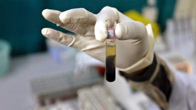 Peneliti BRIN Beberkan Hasil Studi Dugaan Vaksin Covid-19 Penyebab Hepatitis Akut