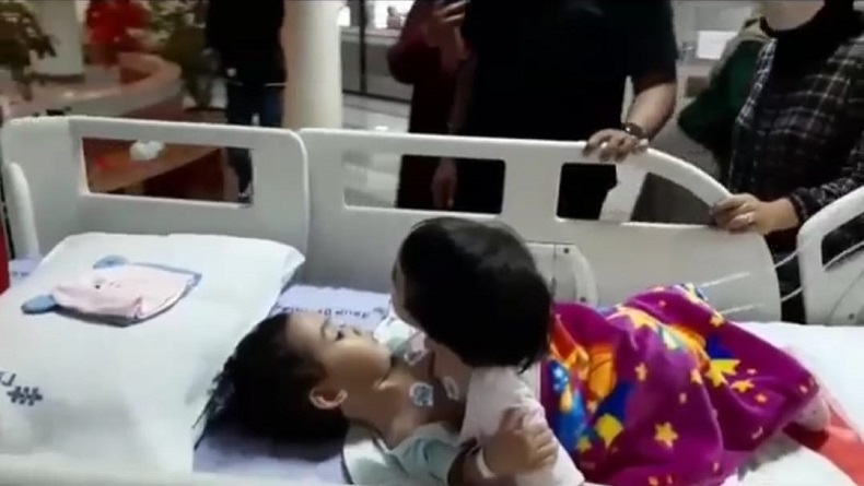 Tim Dokter RSHS Bandung Berhasil Pisahkan Bayi Kembar Siam asal Sukabumi