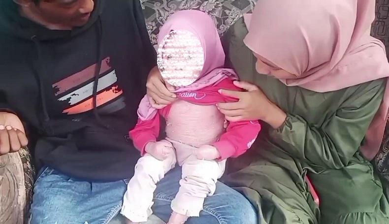 title Balita di Subang Idap Penyakit Langka, Tubuh Bersisik Tebal dengan Gatal Luar Biasa Balita di Subang Idap Penyakit Langka, Tubuh Bersisik Tebal dengan Gatal Luar Biasa