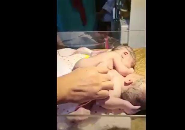 Bayi Kembar Siam Dempet Perut dengan 3 Kaki Lahir di Asahan