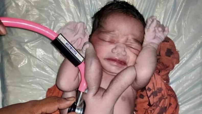  Bayi Ini Dianggap Titisan Dewi Lakshmi lantaran Punya 4 Lengan dan 4 Kaki 