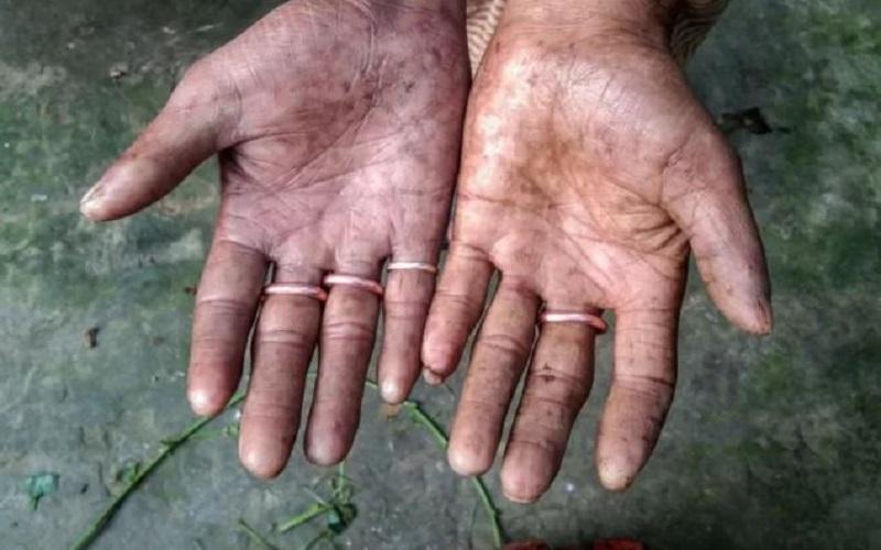 Fenomena Langka, Satu Keluarga Tak Miliki Sidik Jari hingga Tidak Bisa Keluar Negeri