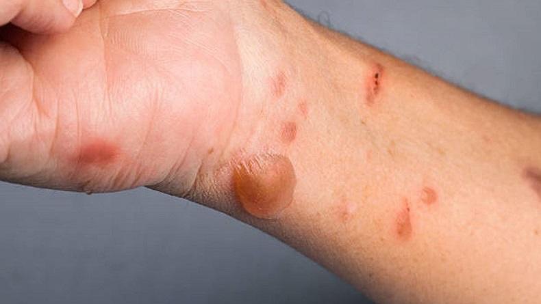 India Dilanda Penyakit Baru, 82 ​​Anak Terpapar Flu Tomat