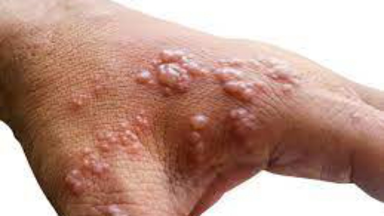 Dinkes Minahasa Tenggara Minta Warga Waspadai Cacar Monyet dengan Terapkan Pola Hidup Bersih