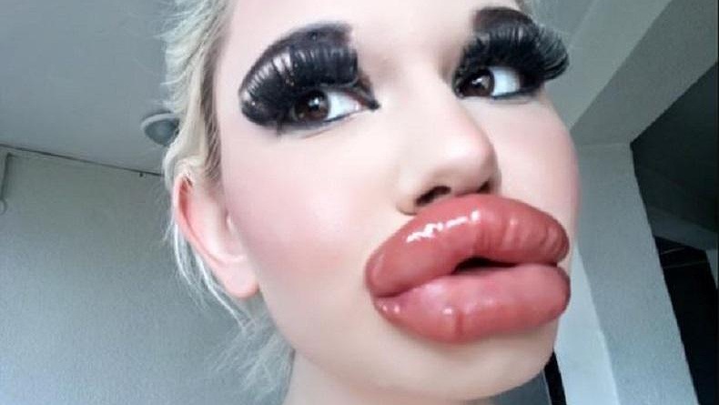 Duh, Perempuan Ini Bangga Punya Bibir Terbesar di Dunia hasil Suntikan