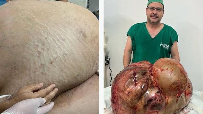 Menakutkan, Pasien Perempuan Idap Tumor Dalam Perut Seberat 45 Kg