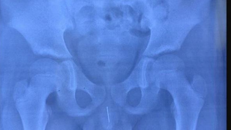 Dokter di China Terkejut Ada Jarum 8 Cm di Penis Bocah 11 Tahun