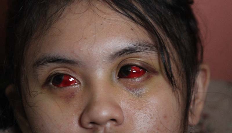 Foto 2 Gadis Cantik Aremania Menderita Mata Merah akibat Terkena Gas Air Mata - Bagian 3