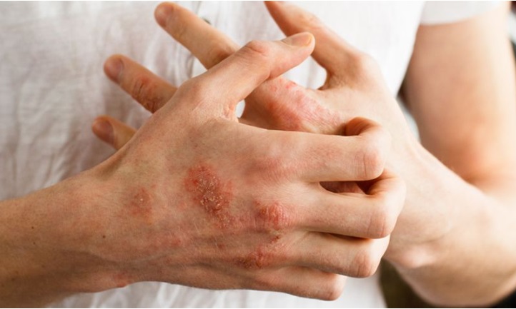 10 Penyebab Bintik Merah pada Kulit, Nomor 8 Tidak Bisa Disembuhkan