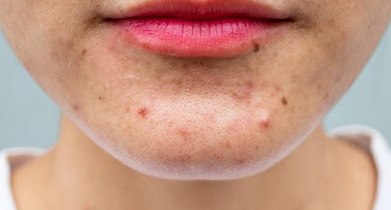  Ingin Atasi Jerawat, Yuk Setop Konsumsi Gorengan