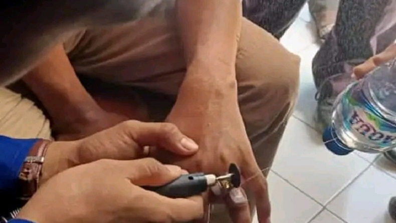 Heboh, Pelajar di Pemalang Panik Tak Bisa Melepas Cincin di Jari Kelingking