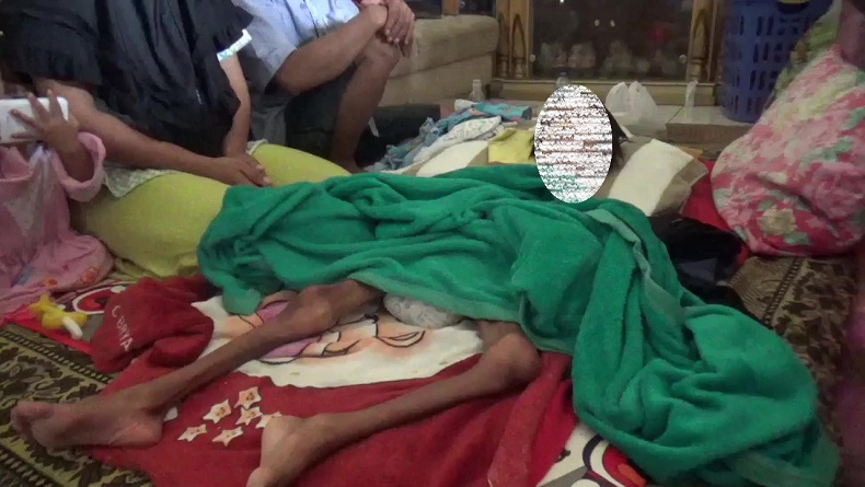 Prihatin, Bocah di Cianjur Gizi Buruk, Orang Tua Sempat Gadaikan Rumah untuk Berobat