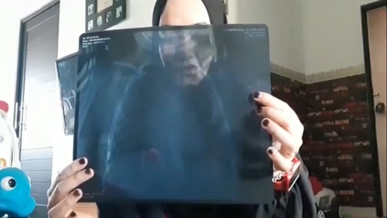 title Guru PAUD Diduga Aniaya Siswa hingga Tulang Patah, Orang Tua Tunjukkan Hasil Rontgen Guru PAUD Diduga Aniaya Siswa hingga Tulang Patah, Orang Tua Tunjukkan Hasil Rontgen