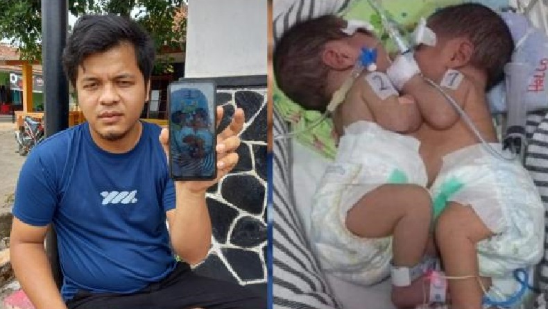RSHS Bandung Laksanakan Operasi Pemisahan Bayi Kembar Siam Hasan-Husen asal Subang