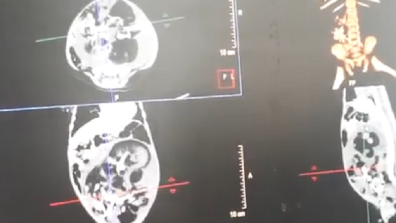 Update Janin Dalam Perut Bayi Laki-Laki di Pesisir Selatan, Kembaran Tak Sempurna