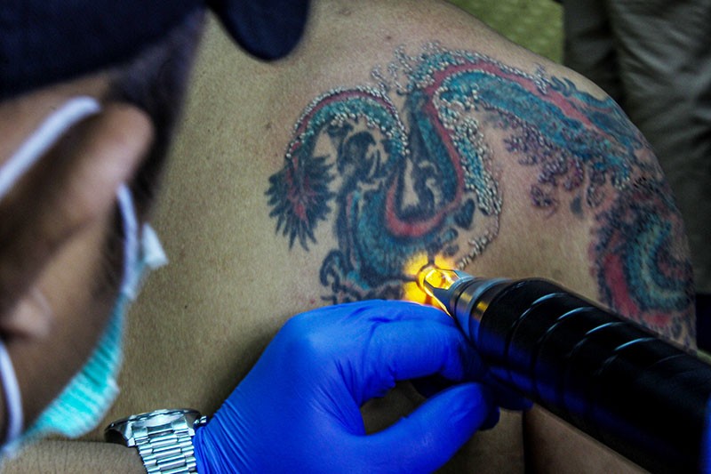 Hapus Tato Gratis dengan Laser - Bagian 2