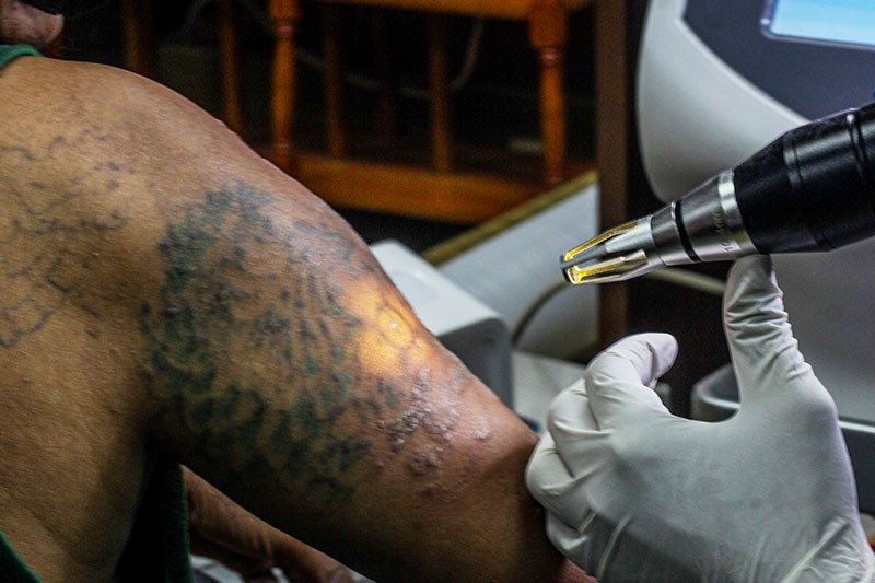 Hapus Tato Gratis dengan Laser - Bagian 4