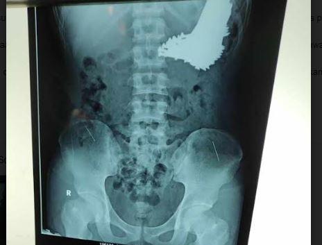 title Ngeri! Tim Dokter Temukan 70 Paku dalam Perut Pria di Indramayu Ngeri! Tim Dokter Temukan 70 Paku dalam Perut Pria di Indramayu