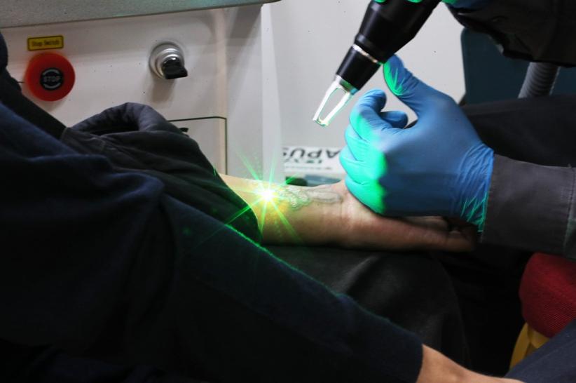 Layanan Hapus Tato Gratis di Balai Kota Jakarta, Ini Jadwalnya - Bagian 1