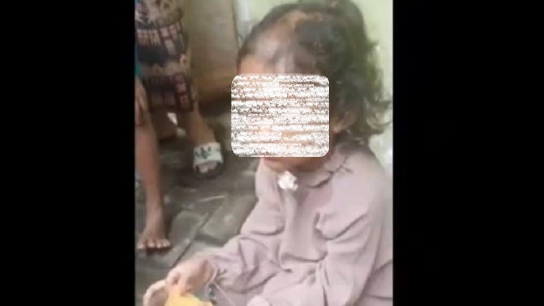 Pilu! Balita Perempuan di Surabaya Diduga Disiksa Paman dan Bibi, Kondisi Mengenaskan 
