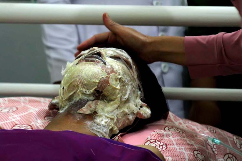 Begini Kondisi Korban Luka Bakar akibat Ledakan Sumur Minyak di Aceh Timur - Bagian 3