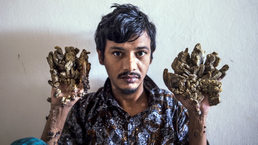 Kutil di Jari Terus Tumbuh, Pria Bangladesh Minta Kedua Tangan Diamputasi - Bagian 1