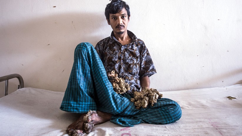 Kutil di Jari Terus Tumbuh, Pria Bangladesh Minta Kedua Tangan Diamputasi - Bagian 2
