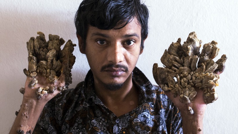 Kutil di Jari Terus Tumbuh, Pria Bangladesh Minta Kedua Tangan Diamputasi - Bagian 3