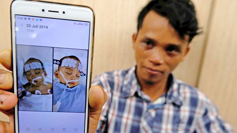 Bayi Kembar Siam di Sumatera Utara Berhasil Dipisahkan, Begini Kondisinya - Bagian 2